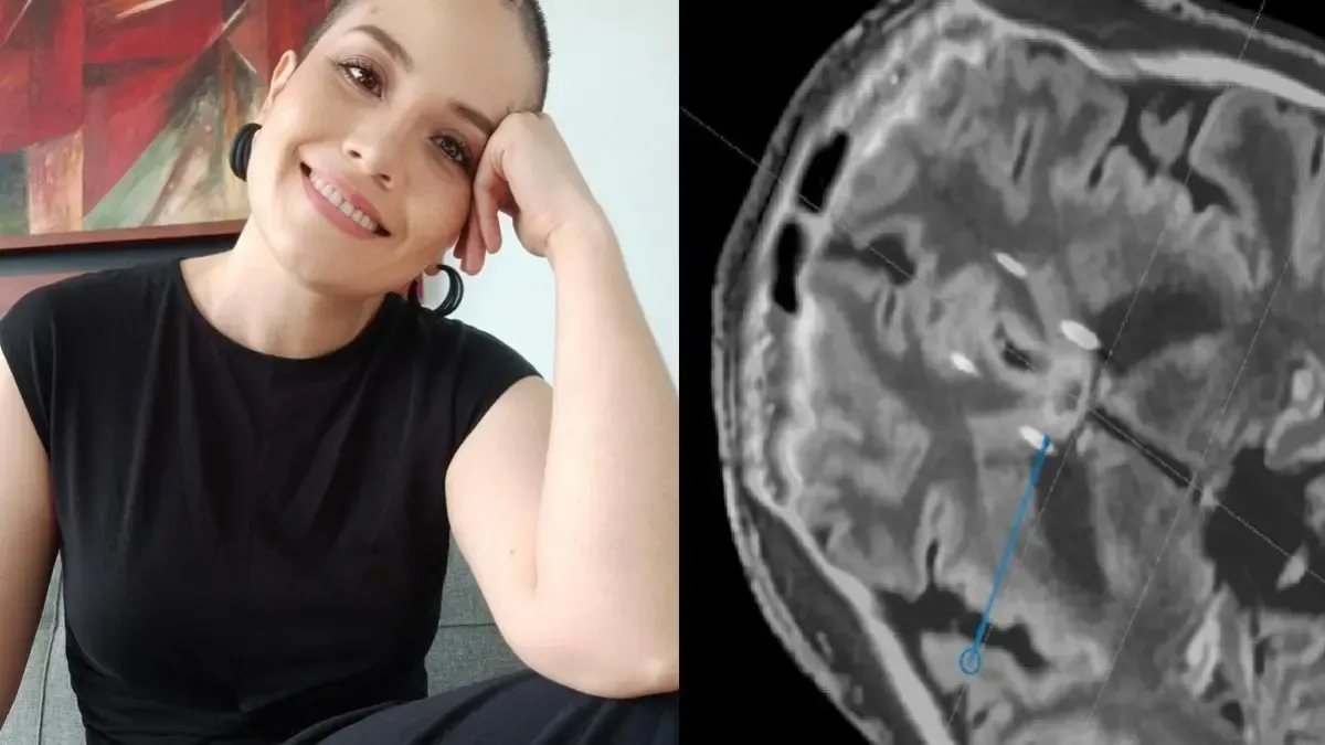 ¿Existe una operación para mejorar la depresión? La historia de una mujer que aprobó el procedimiento cerebral pionero

 – Desde dentro